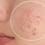 cicatrici acne